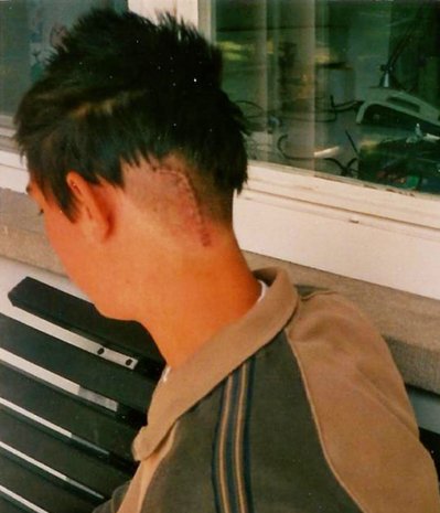 Darius Braun mit 15 kurz nach seiner Operation.